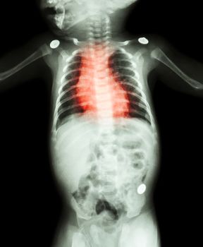 Congenital Heart Disease , Rheumatic Heart Disease ( X-ray whole body of child and red color on heart area )