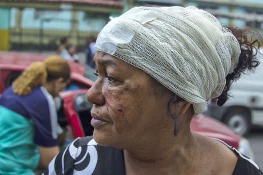 BRAZIL, Rio de Janeiro: A woman stands with bandages on her head after being injured in a building explosion in Rio de Janeiro, Brazil on April 5, 2016.Five  people were killed and nine injured in the explosion. The fire department responded to the blast in the Coelho Neto neighborhood. Neighbors reported the smell of gas leaks for over a year, however the fire department declined to comment on what may have caused the explosion. 