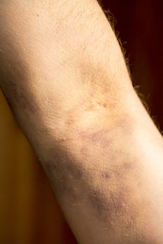 large hematoma on human arm after blood test black background