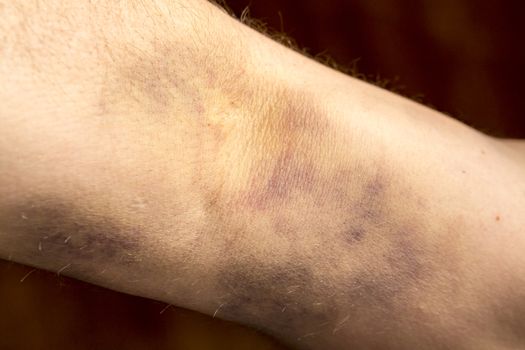 large hematoma on human arm after blood test black background