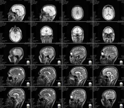 Magnetic resonance imaging of the brain with no visible abnormalities. MRI in different views