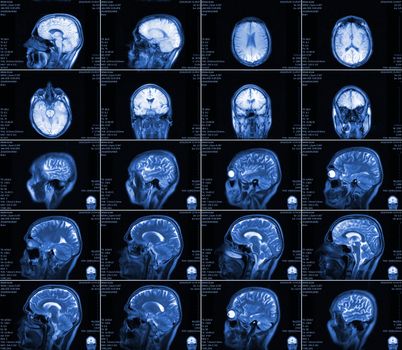 Magnetic resonance imaging of the brain with no visible abnormalities. MRI in different views