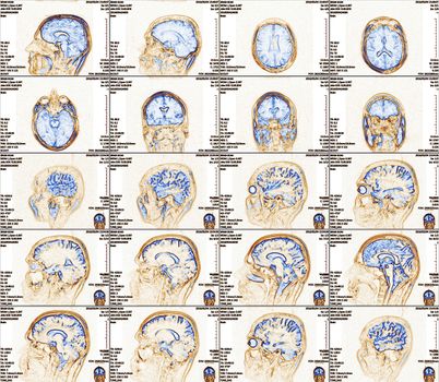 Magnetic resonance imaging of the brain with no visible abnormalities. MRI in different views