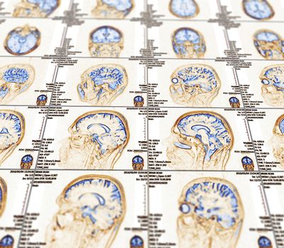 Magnetic resonance imaging of the brain with no visible abnormalities. MRI in different views