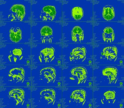 Magnetic resonance imaging of the brain with no visible abnormalities. MRI in different views