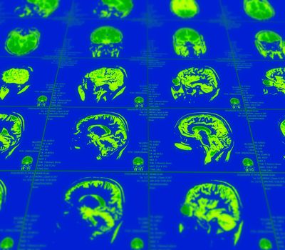 Magnetic resonance imaging of the brain with no visible abnormalities. MRI in different views