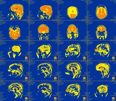 Magnetic resonance imaging of the brain with no visible abnormalities. MRI in different views