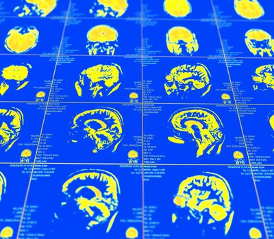 Magnetic resonance imaging of the brain with no visible abnormalities. MRI in different views