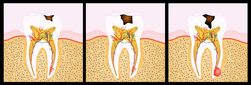 illustration of tooth decay scheme