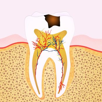 phase of caries