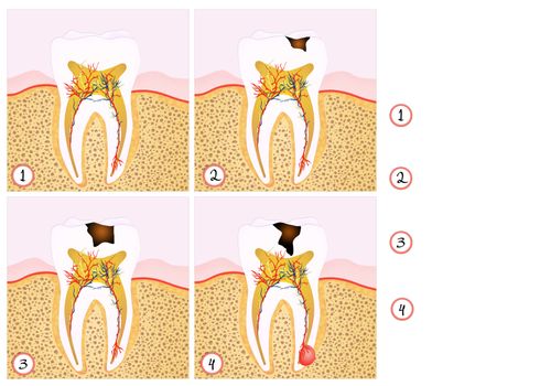 tooth decay scheme