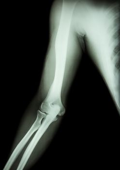 film x-ray of normal arm , elbow and forearm ( black background )