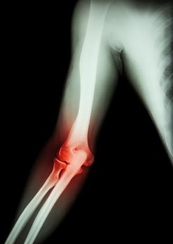 Arthritis at elbow . film x-ray of arm , elbow , forearm and inflammation at elbow ( Gouty arthritis , Rheumatoid arthritis ) ( black background )