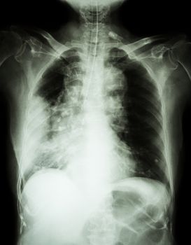 Lung cancer . Film chest x-ray show right lung mass , wide mediastinum , pneumonia and right pleural effusion