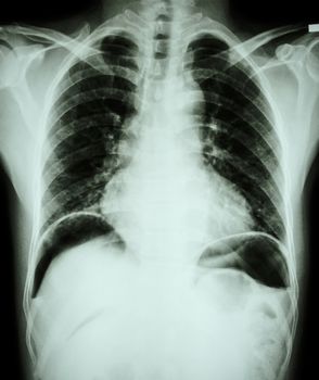 Peptic ulcer perforate . ( film chest x-ray show free air under dome of both diaphragm due to air leak from gastric ulcer or duodenal ulcer perforated ) ( surgical condition and concept )