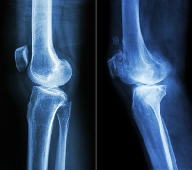 normal knee ( left image ) and osteoarthritis knee ( right image ) ( lateral view )