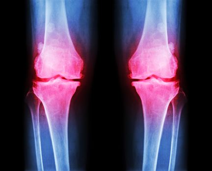 Osteoarthritis both knee . film x-ray AP ( anterior - posterior ) of knee show narrow joint space , osteophyte ( spur ) , subcondral sclerosis
