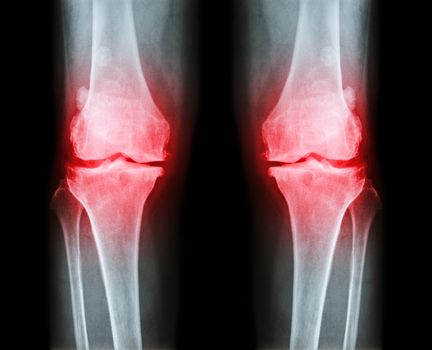 Osteoarthritis both knee . film x-ray AP ( anterior - posterior ) of knee show narrow joint space , osteophyte ( spur ) , subcondral sclerosis