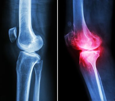 normal knee ( left image ) and osteoarthritis knee ( right image ) ( lateral view )