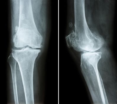 Osteoarthritis knee . film x-ray knee ( anterior - posterior and lateral view ) show narrow joint space , osteophyte ( spur ) , subcondral sclerosis due to degenerative change