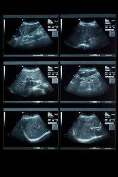 Ultrasonography Analysis of female