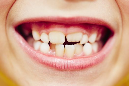 First and second teeth of the little boy