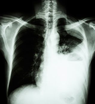 Lung cancer ( film x-ray of chest PA upright : show pleural effusion at left lung due to lung cancer ) ( 2 type of lung cancer : Non-small cell lung cancer , Small cell carcinoma )