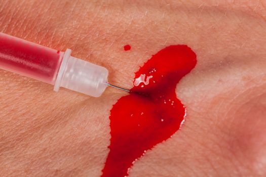 Subcutaneous medical injection concept with a small hypodermic syringe filled with a red liquid penetrating the skin and producing a flow of dripping blood in a close up view