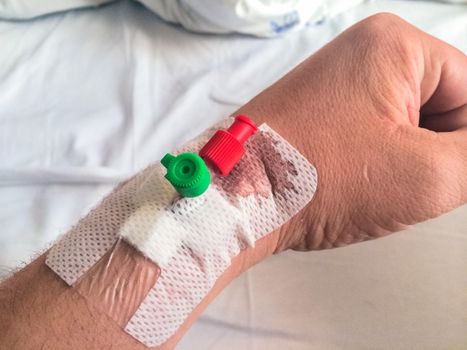 Intravenous cannula, venflon inserted on man's hand with bloodstain.