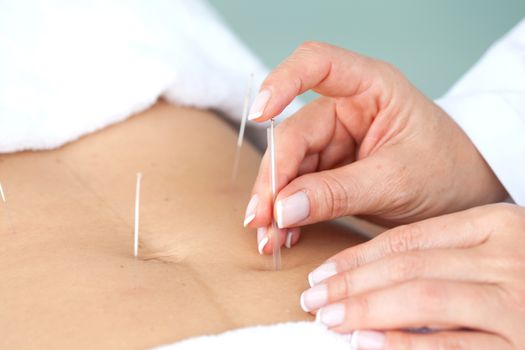 Doctor applying acupuncture on a patient's abdomen