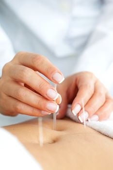 Doctor applying acupuncture on a patient's abdomen