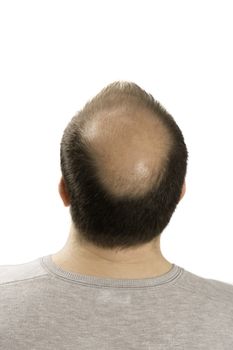 Baldness Alopecia man hair loss haircare medicine bald treatment transplantation