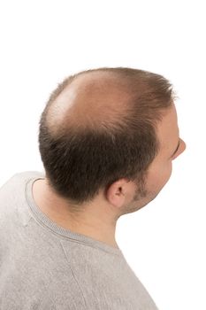 Baldness Alopecia man hair loss haircare medicine bald treatment transplantation