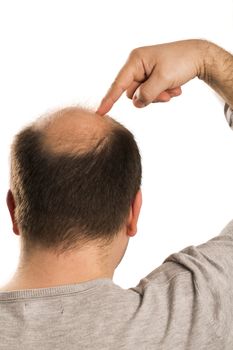 Baldness Alopecia man hair loss haircare medicine bald treatment transplantation