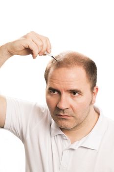 Baldness Alopecia man hair loss haircare medicine bald treatment transplantation