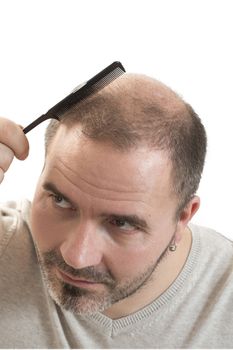 Baldness Alopecia man hair loss haircare medicine bald treatment transplantation