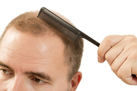 Baldness Alopecia man hair loss haircare medicine bald treatment transplantation