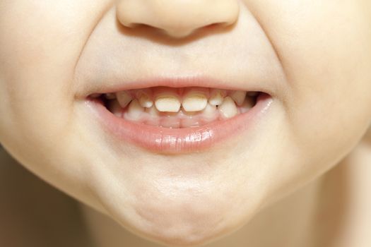 photographed close-up baby's mouth, the boy with the teeth, the teeth traces of caries,