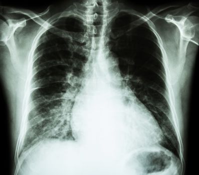 Heart failure ( film x-ray chest PA upright : show cardiomegaly and interstitial infiltrate both lung )