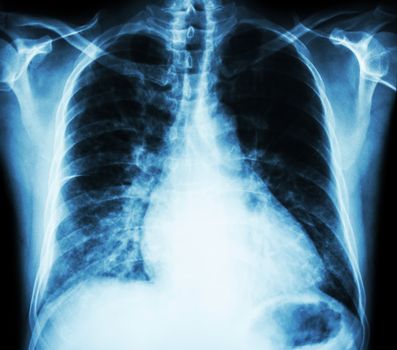 Heart failure ( film x-ray chest PA upright : show cardiomegaly and interstitial infiltrate both lung )