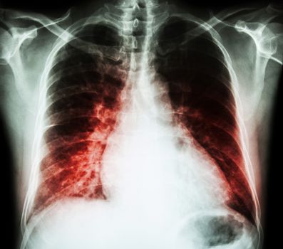 Heart failure ( film x-ray chest PA upright : show cardiomegaly and interstitial infiltrate both lung )