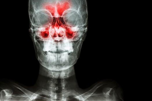 Sinusitis. film x-ray skull AP ( anterior - posterior ) show infection and inflammation at frontal sinus , ethmoid sinus , maxillary sinus and blank area at right side