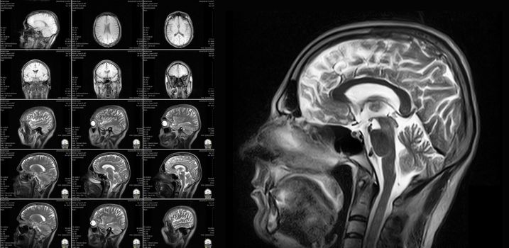 Magnetic resonance imaging of the brain with no visible abnormalities. MRI in different views