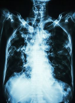 Pulmonary Tuberculosis . film chest x-ray of old patient show interstitial infiltration both lung and calcification at trachea ( can seen shape of trachea )