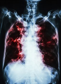 Pulmonary Tuberculosis . film chest x-ray of old patient show interstitial infiltration both lung and calcification at trachea ( can seen shape of trachea )