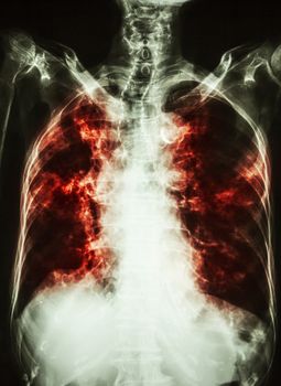 Pulmonary Tuberculosis . film chest x-ray of old patient show interstitial infiltration both lung and calcification at trachea ( can seen shape of trachea )