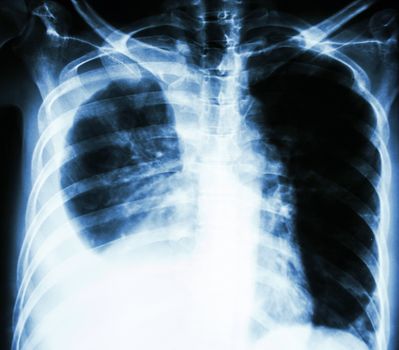 film chest X-ray PA upright : show pleural effusion at right lung due to lung cancer