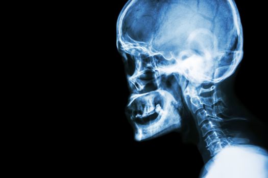 Film x-ray Skull lateral view show normal human's skull and cervical spine and blank area at left side