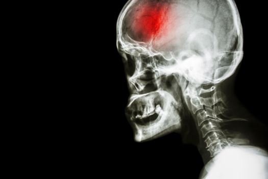 Stroke . film x-ray skull and cervical spine lateral view and stroke . cerebrovascular accident . blank area at left side .