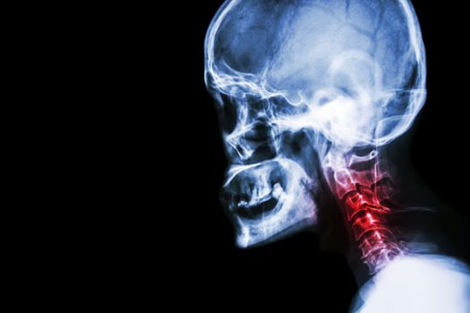 Cervical spondylosis . film x-ray skull lateral view and neck pain .